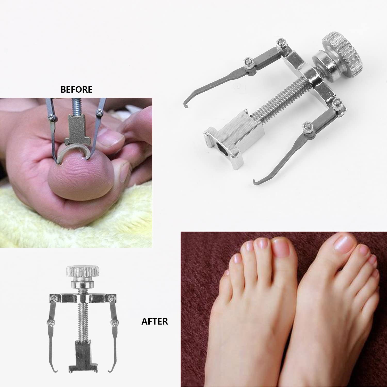 Ingrown Toenail Correction Tool Nail Correction Kit Toe Clamp Stainless Steel Toenail Lifter Toes Treatment Pedicure Tool (1 Pc)