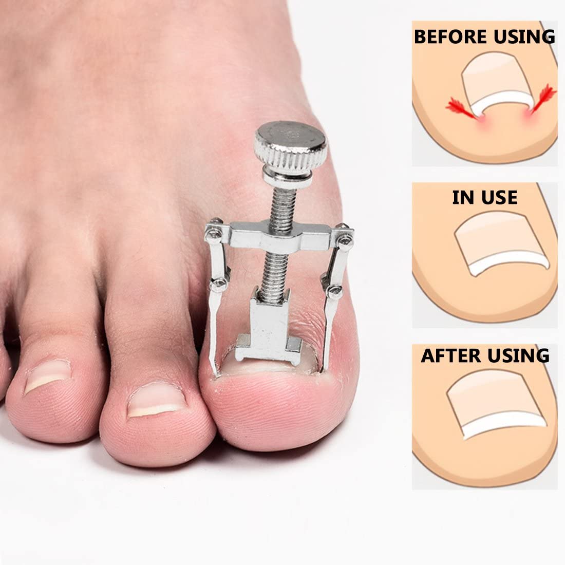 Ingrown Toenail Correction Tool Nail Correction Kit Toe Clamp Stainless Steel Toenail Lifter Toes Treatment Pedicure Tool (1 Pc)