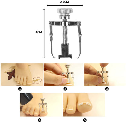 Ingrown Toenail Correction Tool Nail Correction Kit Toe Clamp Stainless Steel Toenail Lifter Toes Treatment Pedicure Tool (1 Pc)