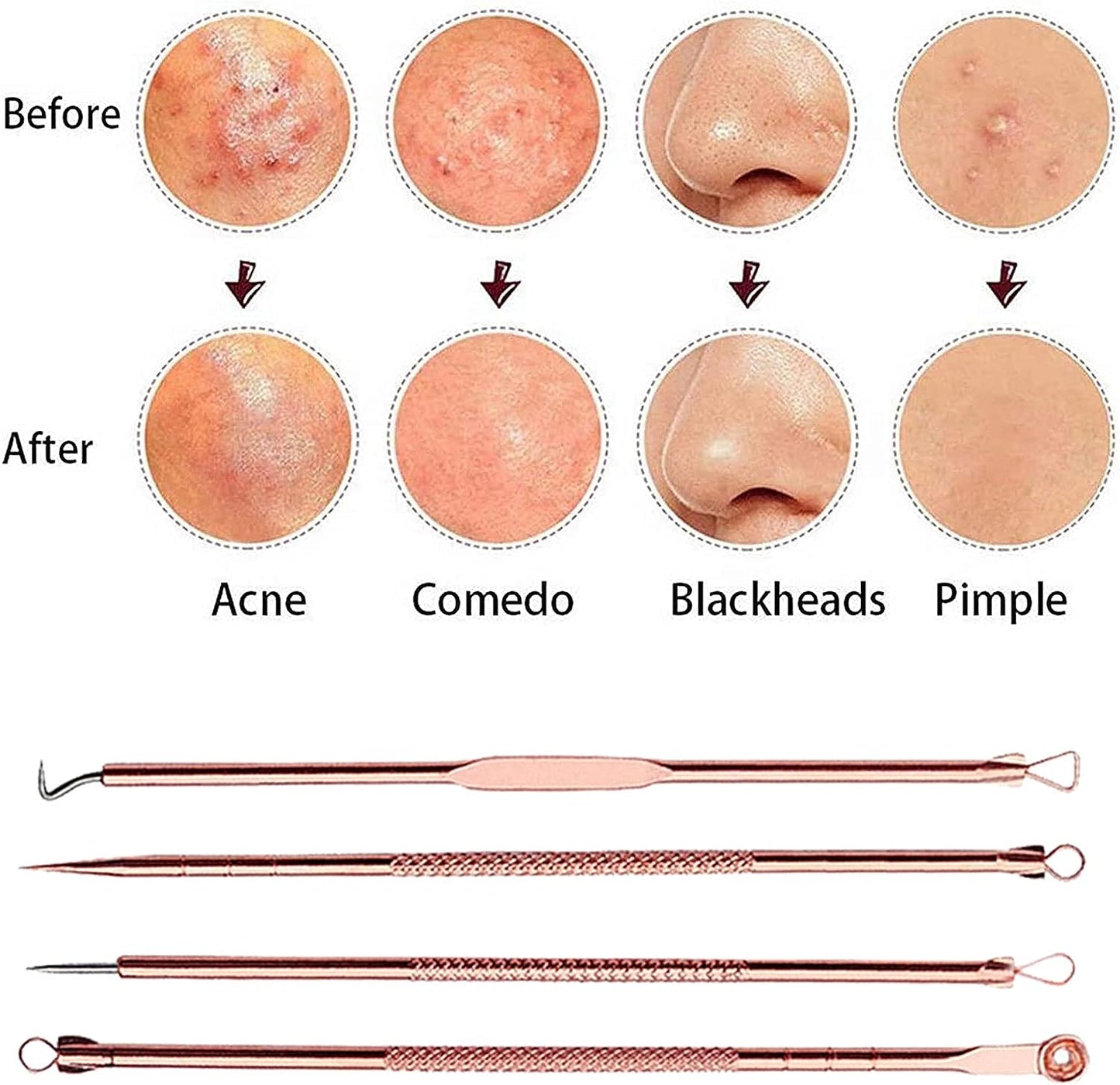 4 Pcs/Set Acne Blackhead Removal Needles Stainless Pimple Spot Comedone Extractor Cleanser Beauty Face Clean Care Tools